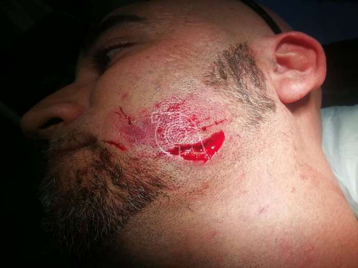 Carlos Yerove recibió una mordida en el rostro que le propició una herida abierta (Foto cedida a TA por la víctima)